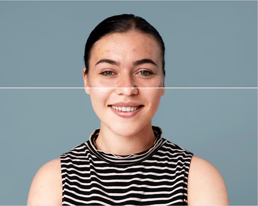 Acne, active breakouts and clogged pores