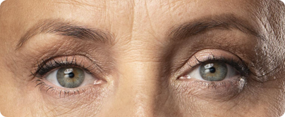 11 Lines (Frown Lines / Glabella)